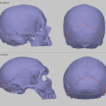 As gens neandertais podem descrever um distúrbio onde as combinações de capô estão fora de crânios
