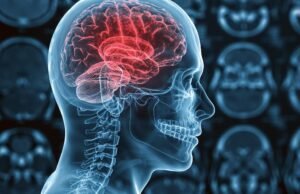 Microinfarotos cerebrais: como identificar esse tipo de golpe