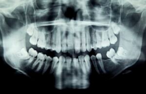 Condição de diagnóstico: o problema dental da menina causou olhos que ameaçam a vida infectados