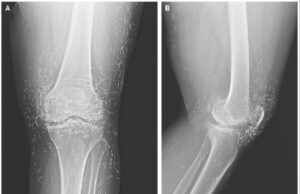 Dilema de diagnóstico: dor intensa no joelho de uma mulher revela “fios de ouro” em suas articulações