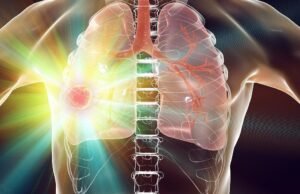 Um guia de robô para atingir um tumor profundo nos pulmões