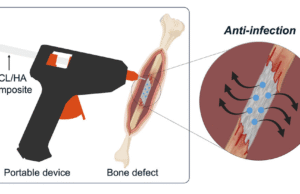 Os cientistas desenvolvem uma “pistola de cola” que imprimiu os ossos do enxerto diretamente em fraturas