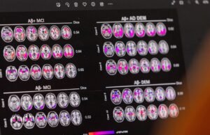 O câncer pode atuar como um escudo contra o Alzheimer: proteínas tumorais fornecem pistas importantes