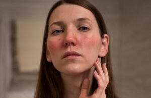Eczema: como identificar alimentos que pioram os sintomas e quando é necessário procurar ajuda médica, segundo especialistas