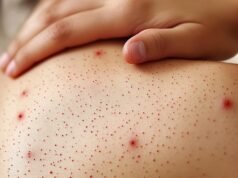 Primeira morte confirmada por sarampo em Guerrero: criança de 2 anos