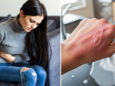 Queimaduras e envenenamentos aumentam na Semana Santa: EsSalud oferece recomendações para evitar emergências durante viagens