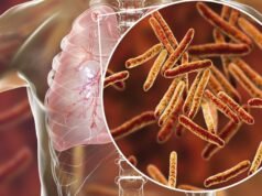 A Europa perde um em cada cinco casos de tuberculose, segundo um relatório