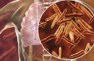 A Europa perde um em cada cinco casos de tuberculose, segundo um relatório