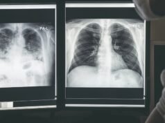 Os primeiros 10 sintomas de câncer de pulmão que podem passar despercebidos