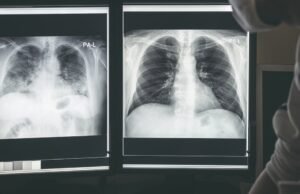 Os primeiros 10 sintomas de câncer de pulmão que podem passar despercebidos