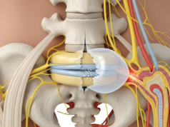 Ciática: causas, sintomas e recomendações de Minsa