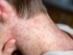 El Salvador: Saúde detecte casos de sarampo, conheça os sintomas e como se proteger