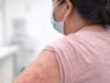 O Ministério da Saúde solicitou o uso de máscaras faciais em caso de sintomas respiratórios e erupções cutâneas.