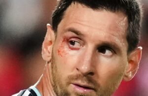 A fratura no olho sofrida por Lionel Messi durante a partida entre Argentina e Suíça pela Copa do Mundo de 2026.