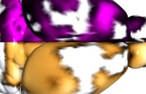 Cientistas espanhóis descobriram pela primeira vez os microtrombos que causam a doença de Alzheimer